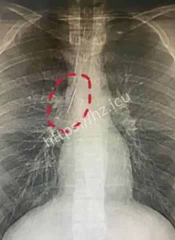 安徽17岁小伙胸腔藏5厘米缝衣针